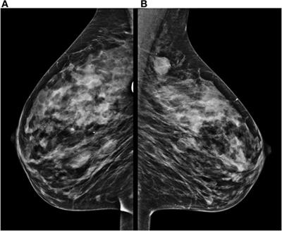 Granulocytic Sarcoma Presenting as a Palpable Breast Lump